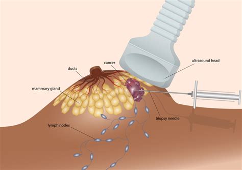 Extra Nipples: Formation, Diagnosis, and Treatment